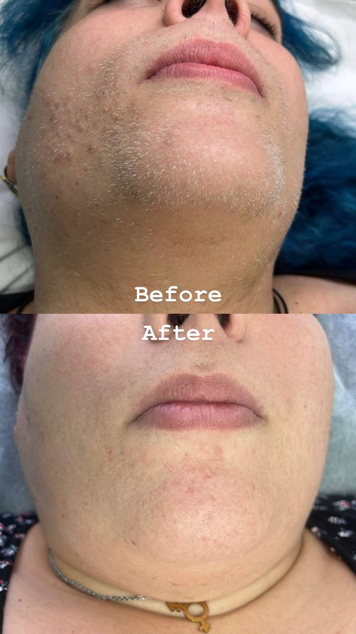 PCOS hormonal hair electrolysis Barcelona