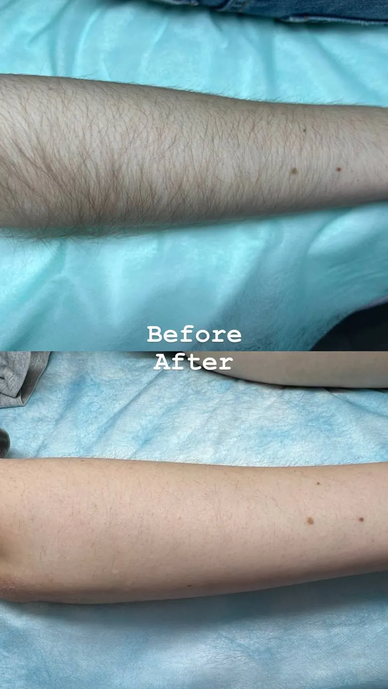 Antes y después: electrólisis en el brazo