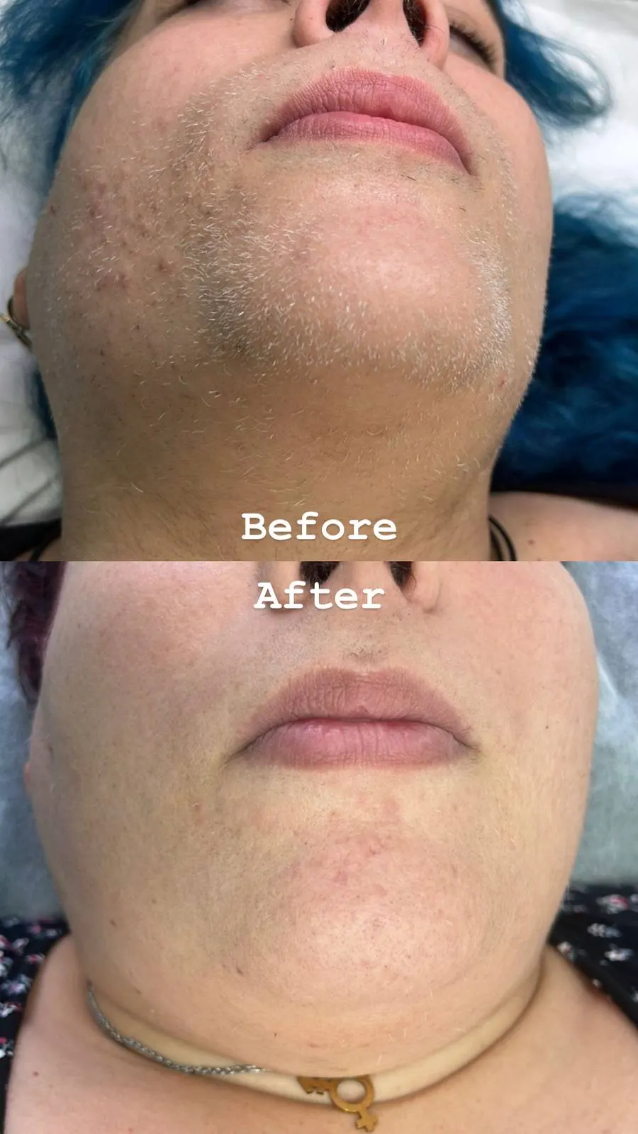 Antes y después: electrólisis facial en el mentón