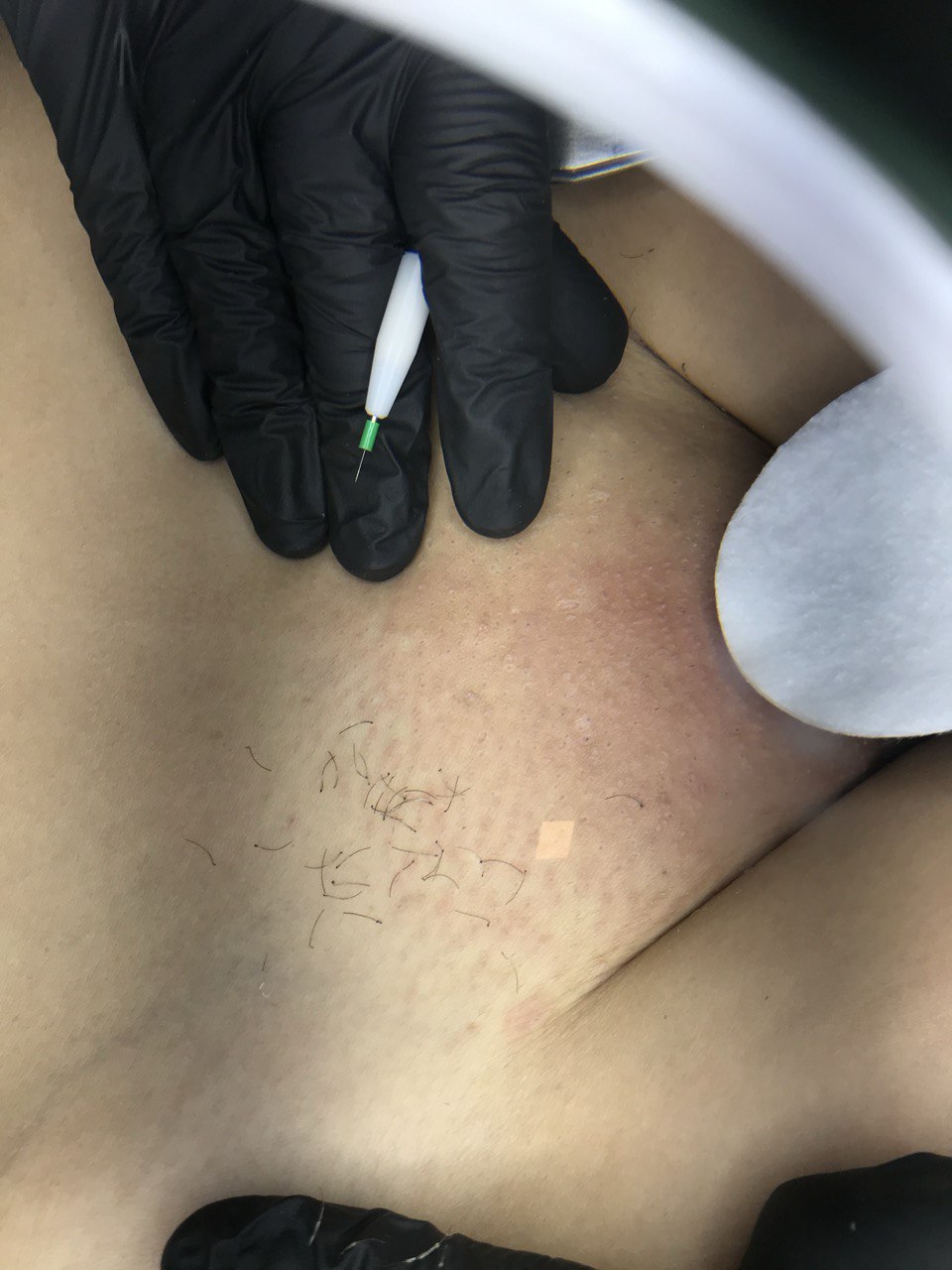 Bikini electrolysis Barcelona