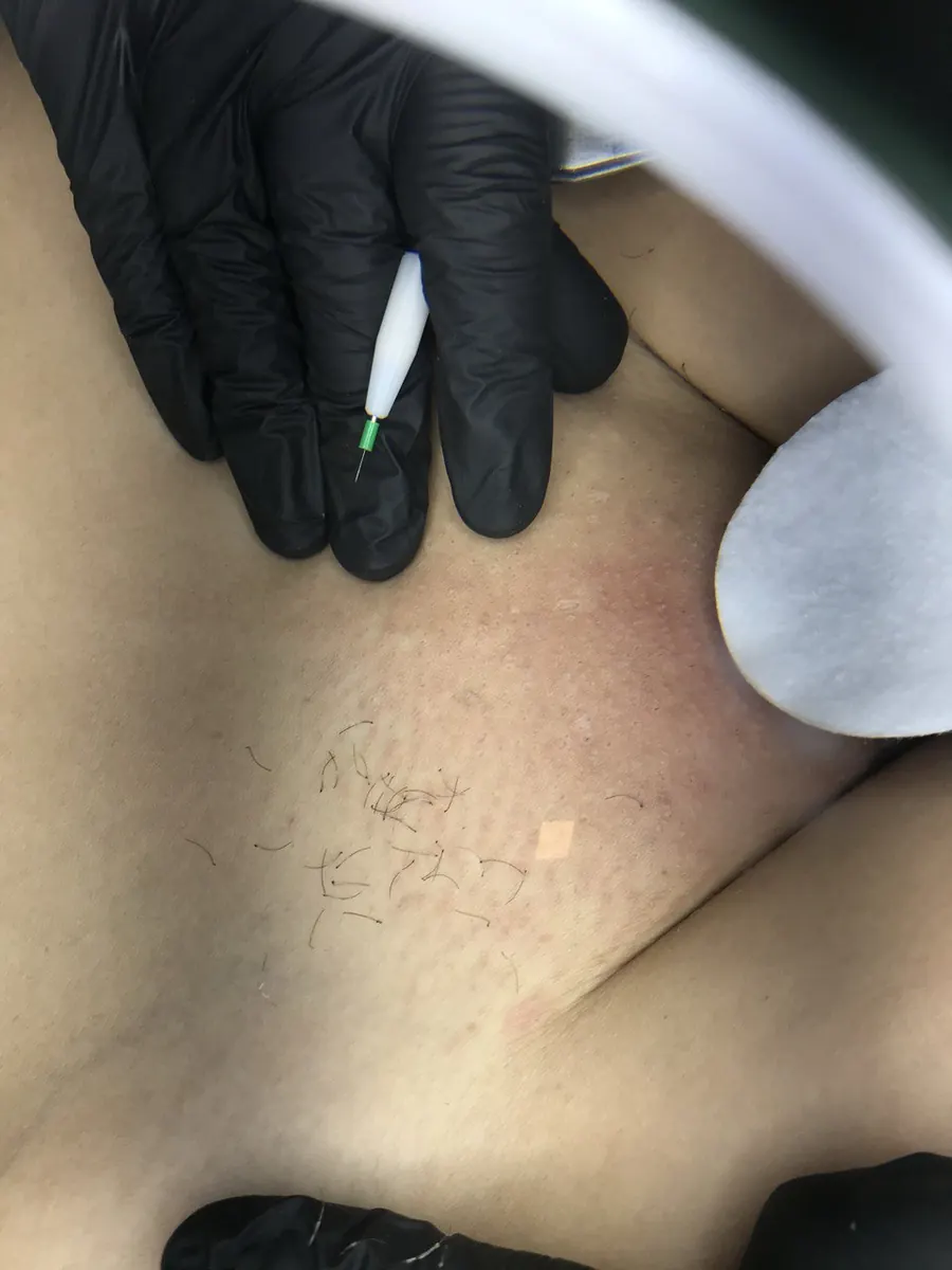Electrólisis en la zona del bikini