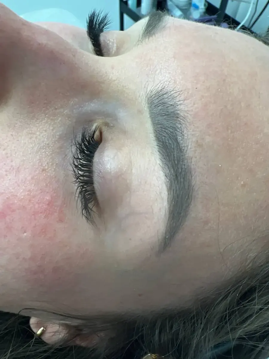 Electrólisis facial en la zona de las cejas