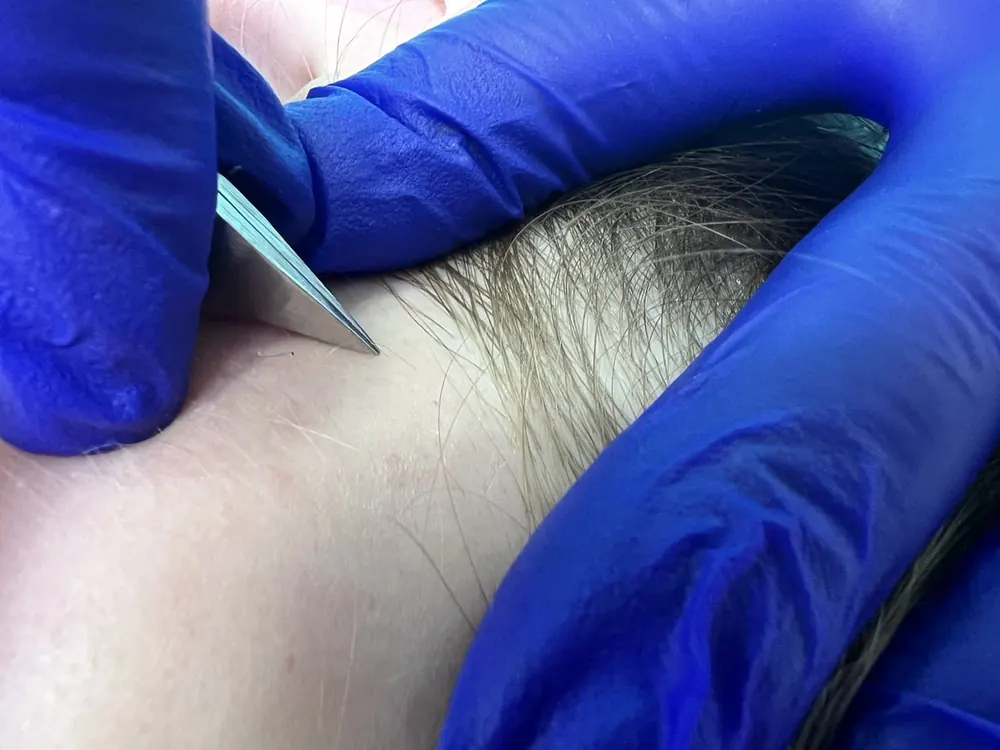 Electrólisis para pelo blanco y canoso Barcelona
